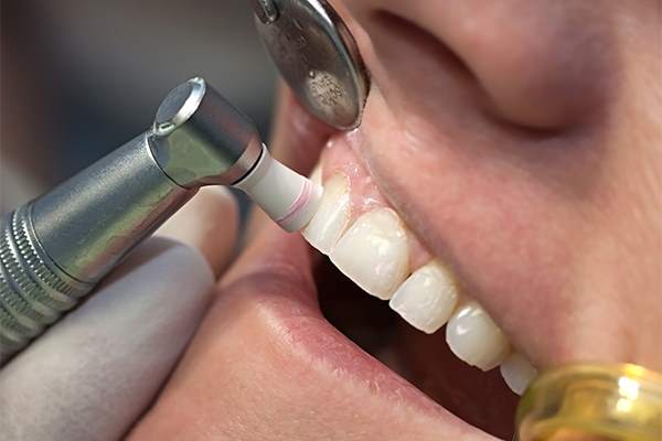 Trattamento igiene orale