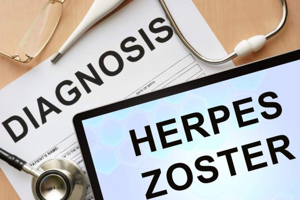 herpes zoster