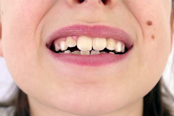 Denti storti
