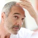 Caduta dei Capelli