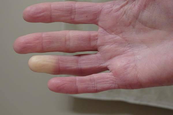 Sindrome di Raynaud