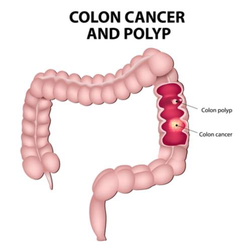 Colon polipi