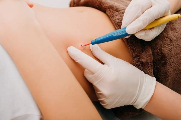 tumore benigno rimozione