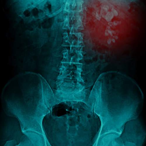 Sardine controindicazioni