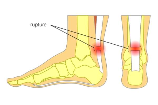 anatomia tendine di achille