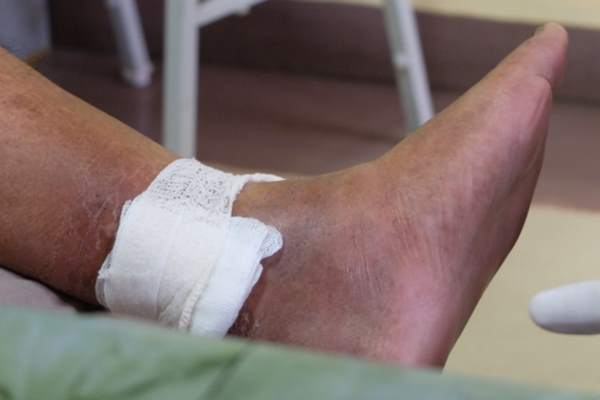 ulcere venose trattamento