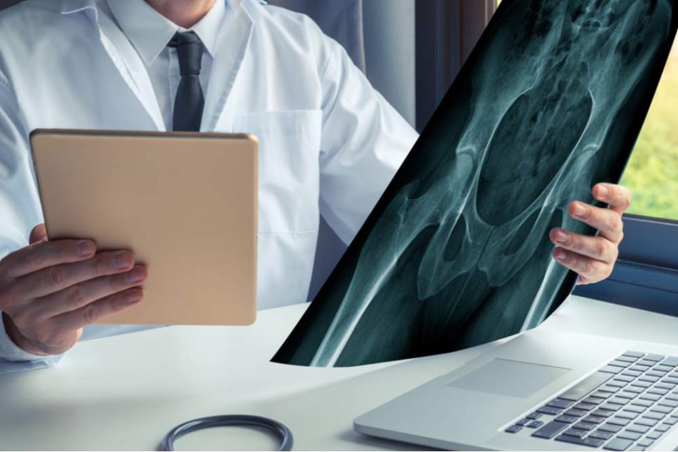 frattura femore anziani