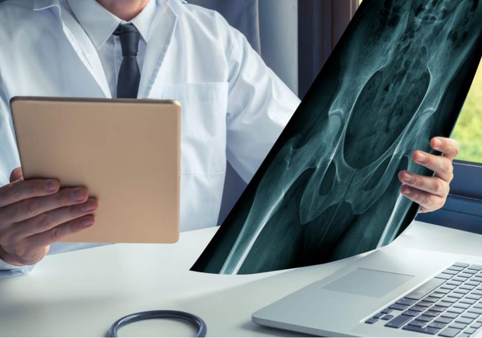 frattura femore anziani