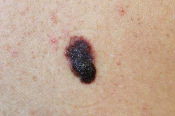 melanoma
