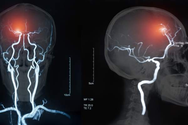 ictus cerebrale diagnosi