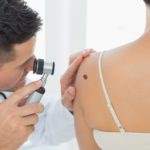 melanoma cutaneo