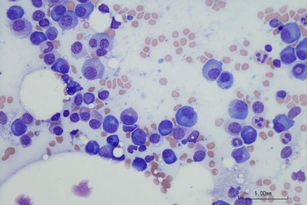 cellule mieloma