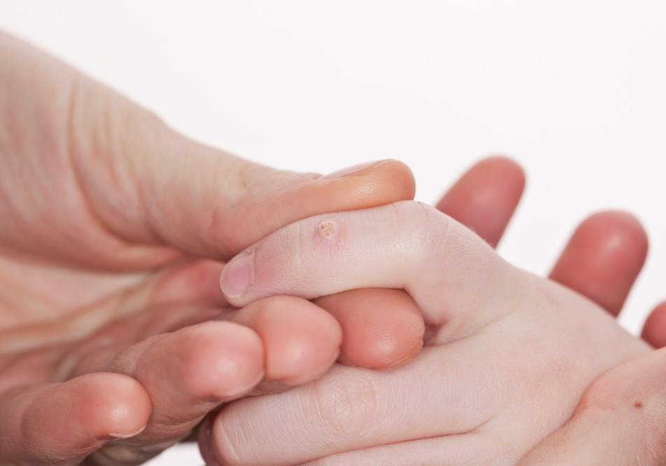 verruche-mani verruche mani