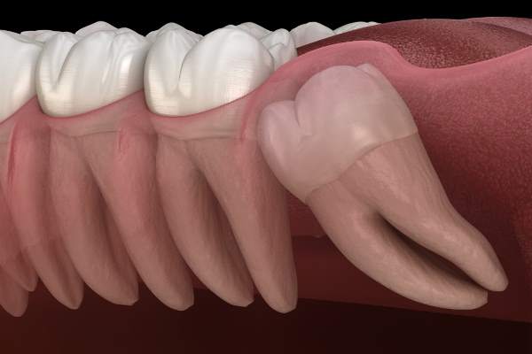 Illustrazione cisti dentale Cisti dentale illustrazione