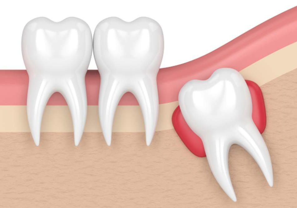 Cisti-dentale-illustrazione Illustrazione cisti dentale