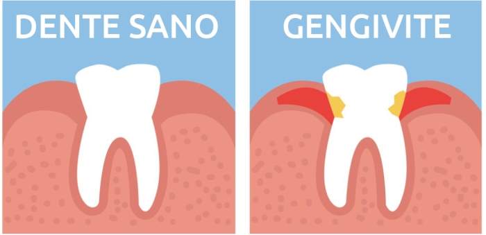dente sano e dente con gengivite