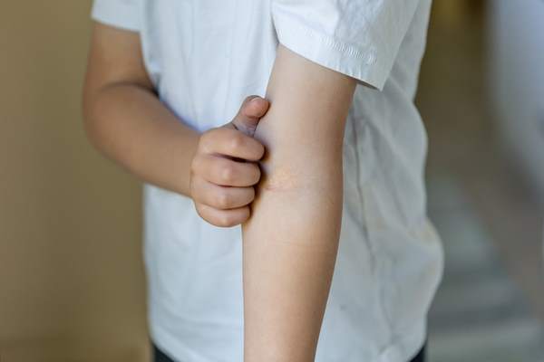 impetigine bambini foto