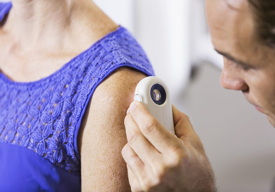 cheratosi seborroica