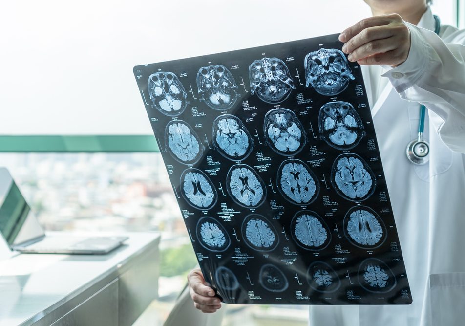 La meningite è un'infiammazione delle meningi che proteggono cervello e midollo spinale. Riconoscere i suoi sintomi è essenziale per intervenire rapidamente e prevenire complicazioni gravi.