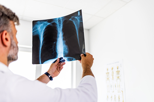 Uomo con sintomi di tumore ai polmoni che si espone a un esame radiografico al torace