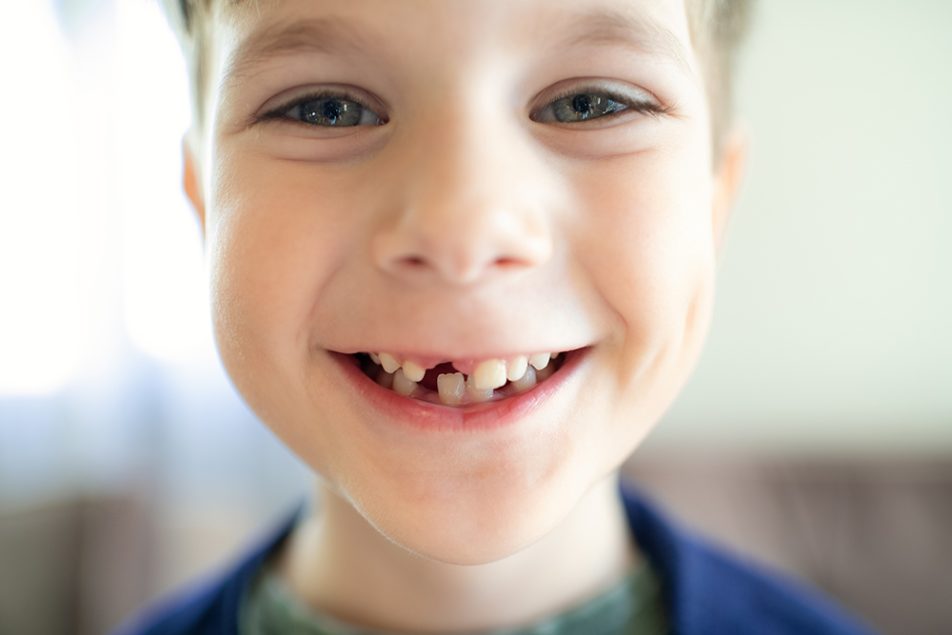 sorriso-bambino-denti-da-latte Sorriso di un bambino gioioso con denti da latte