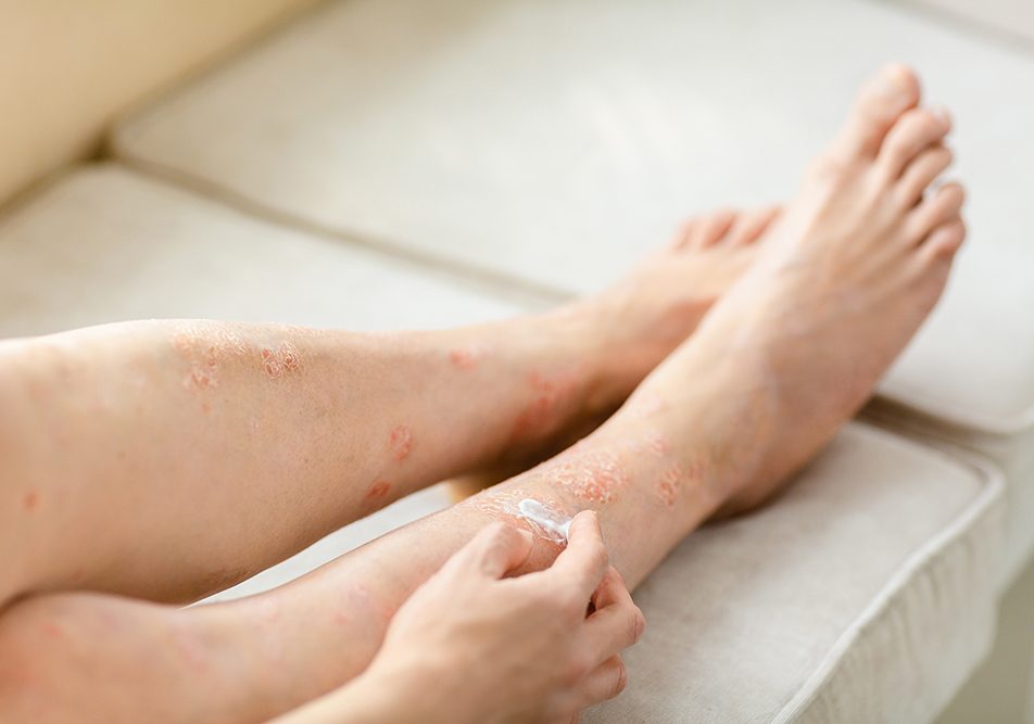 Donna che cura in casa le sue gambe affette da dermatite da stasi, applicando una crema emolliente sulla pelle secca