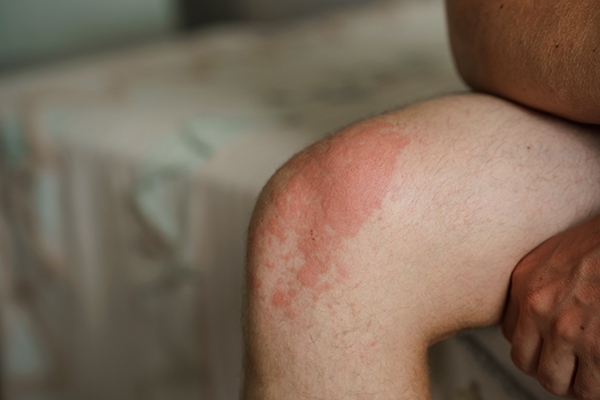 Uomo seduto ai bordi del letto con macchie rosse sulle gambe all’altezza del ginocchio