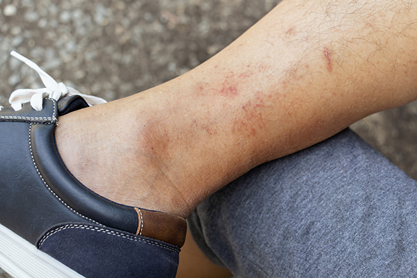 Uomo che indossa un paio di mocassini mentre è in sosta durante una camminata, soffrendo di dermatiti pruriginose nella zona delle caviglie
