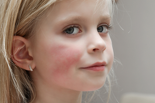 Bambina con dermatite atopica sulle guance che manifesta arrossamenti nell’area interessata