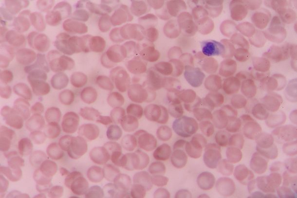 cellula-staminale-neoplasia-mieloproliferativa Cellula staminale al microscopio: focus sulla neoplasia mieloproliferativa