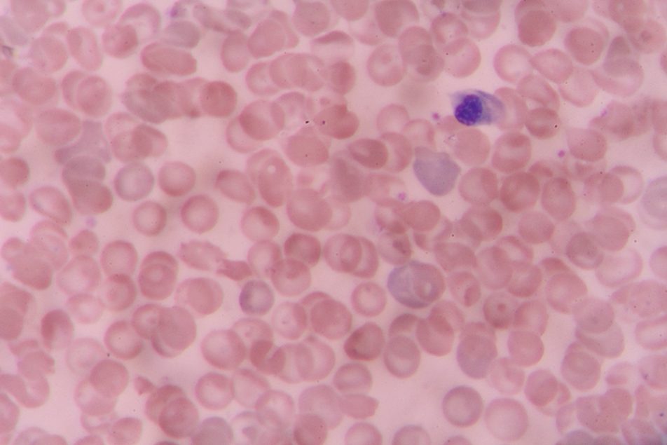 cellula-staminale-neoplasia-mieloproliferativa Cellula staminale al microscopio: focus sulla neoplasia mieloproliferativa