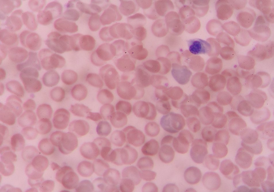 cellula-staminale-neoplasia-mieloproliferativa Cellula staminale al microscopio: focus sulla neoplasia mieloproliferativa