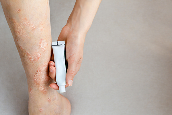 Donna che cura la dermatite atopica nella zona dei polpacci applicando una crema emolliente e lenitiva sotto indicazione del dermatologo