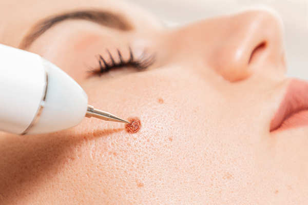 Donna dal dermatologo per una visita di controllo, che analizza una neoformazione cutanea sita nella zona delle guance