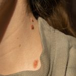 Donna colpita dai raggi solari che si prende cura della salute della sua pelle e dei suoi nei al fine di evitare l’insorgenza di un’eventuale neoplasia e di altre patologie