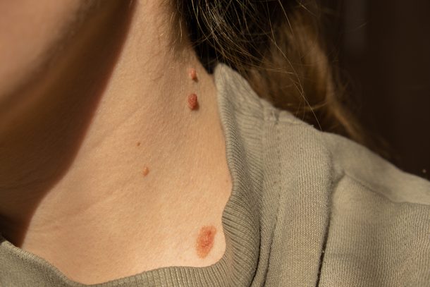 donna-colpita-dai-raggi-solari-curando-salute-della-pelle-evitando-neoplasia Donna colpita dai raggi solari che si prende cura della salute della sua pelle e dei suoi nei al fine di evitare l’insorgenza di un’eventuale neoplasia e di altre patologie
