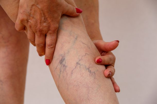 donna-com-flebite-gamba-vene-varicose Gambe di donna che soffre di flebite e con le vene varicose