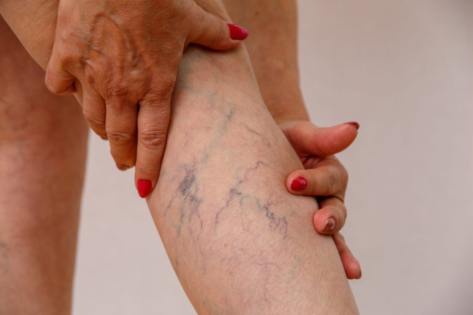 Gambe di donna che soffre di flebite e con le vene varicose