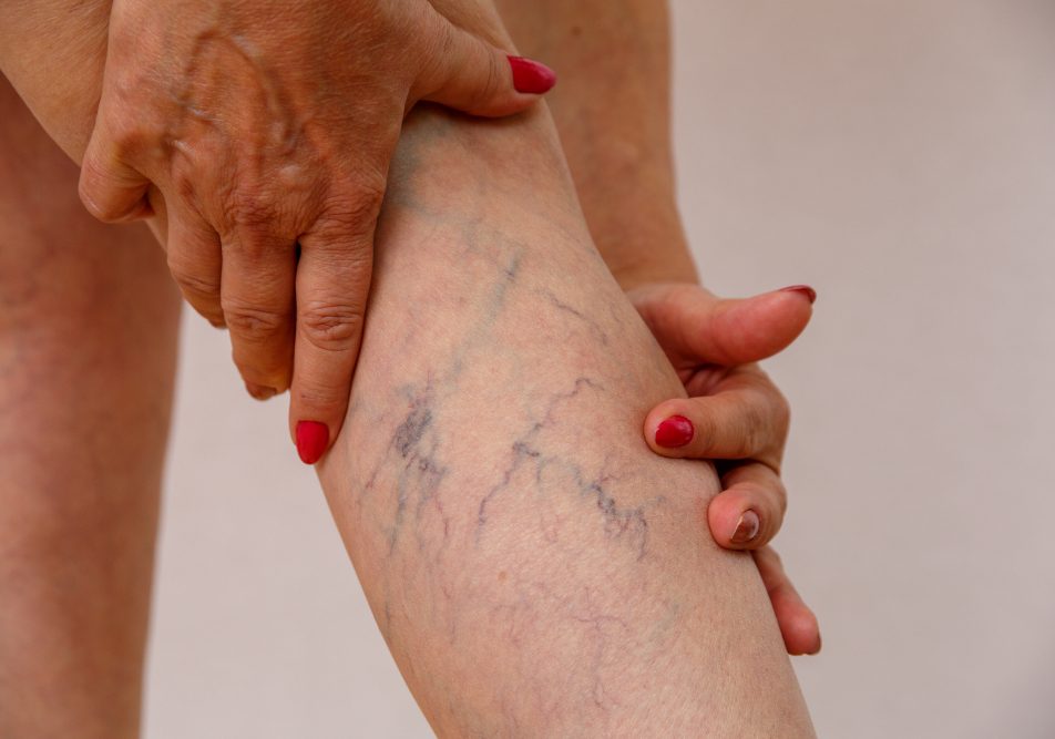 donna-com-flebite-gamba-vene-varicose Gambe di donna che soffre di flebite e con le vene varicose