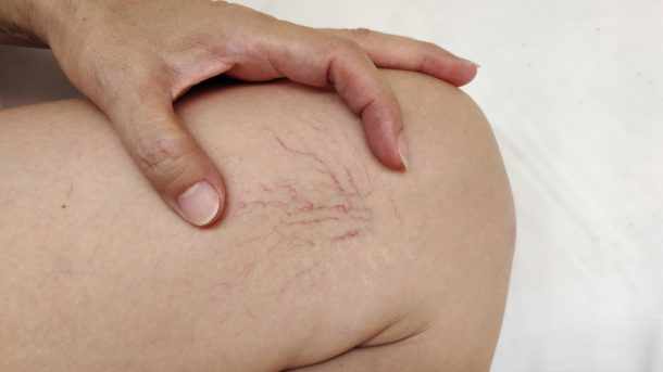 Gambe di donna con presenza di capillari rotti