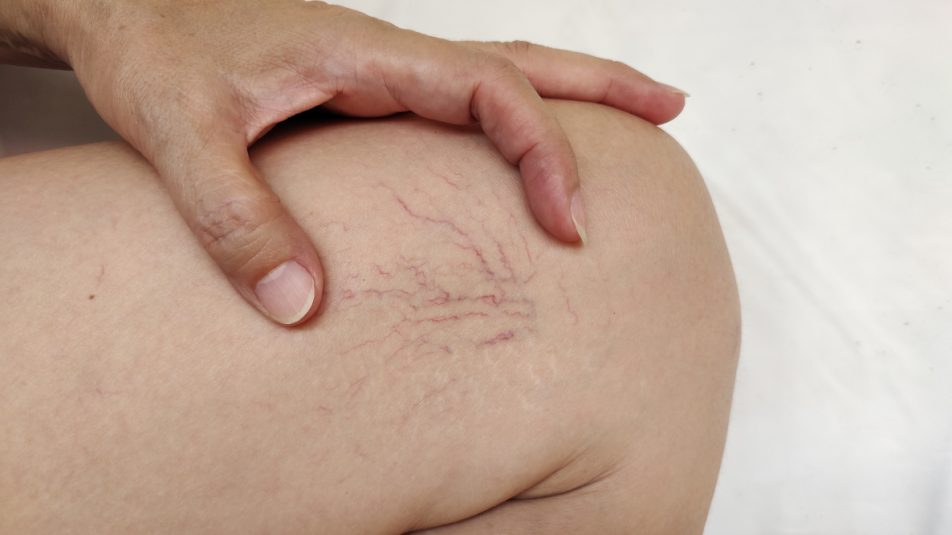Gambe di donna con presenza di capillari rotti