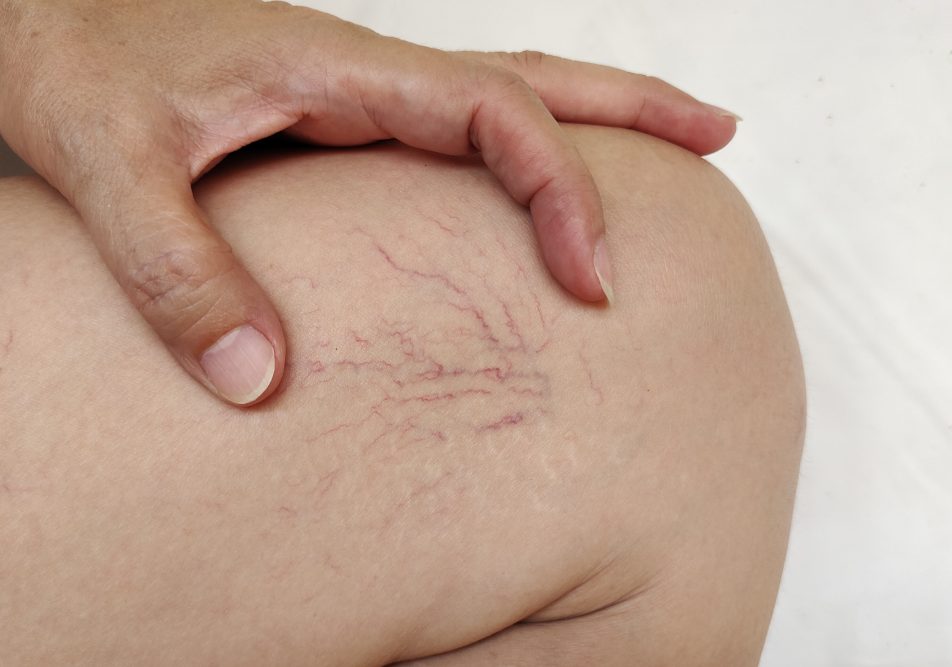 Gambe di donna con presenza di capillari rotti