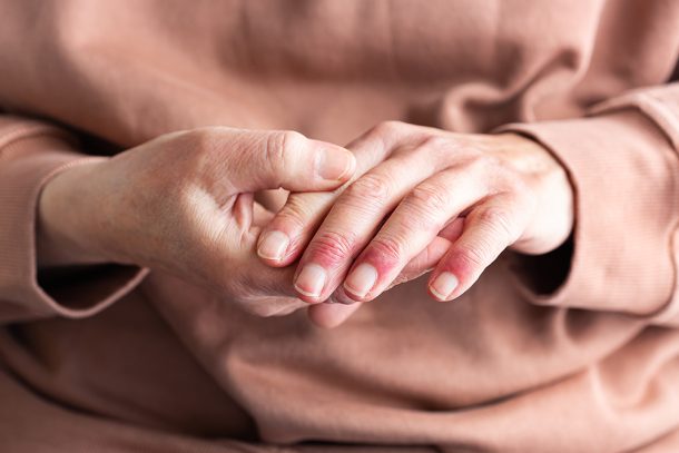 donna-con-dermatite-atopica-toccandosi-mani-e-polpastrelli Donna con dermatite atopica sulle mani si tocca le mani e i polpastrelli gonfi e arrossati