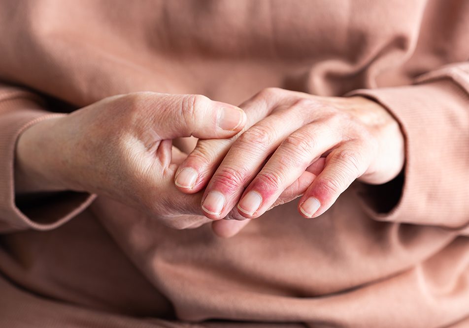 donna-con-dermatite-atopica-toccandosi-mani-e-polpastrelli Donna con dermatite atopica sulle mani si tocca le mani e i polpastrelli gonfi e arrossati