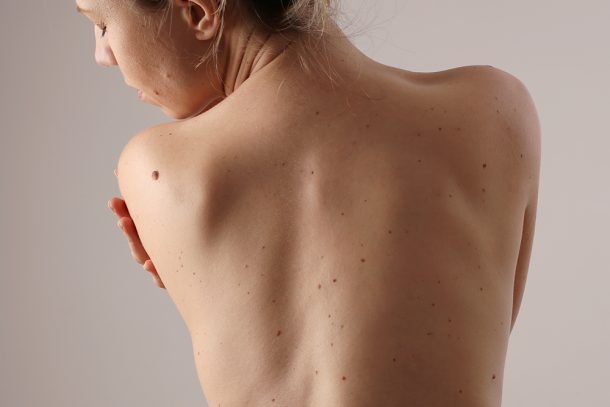 Donna dalla carnagione chiara con evidenti nei diffusi che si prende cura della sua pelle prevenendo l’insorgenza della neoplasia cutanea