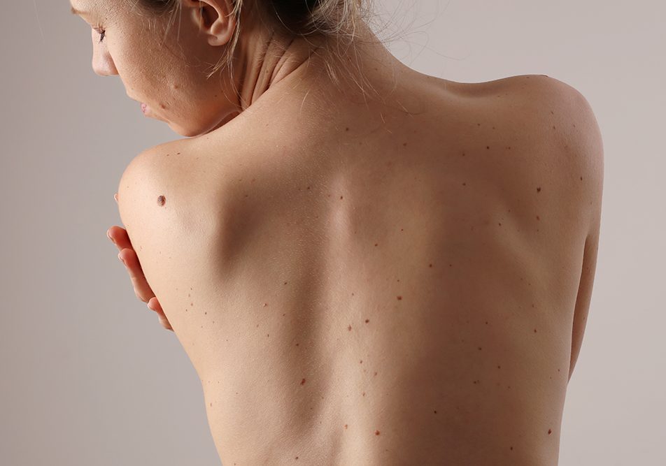 donna-con-nei-prendendosi-cura-della-sua-pelle-prevenzione-neoplasia Donna dalla carnagione chiara con evidenti nei diffusi che si prende cura della sua pelle prevenendo l’insorgenza della neoplasia cutanea