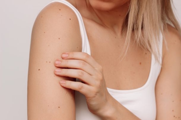Donna si controlla la pelle per verificare eventuali cambiamenti e combattere il melanoma