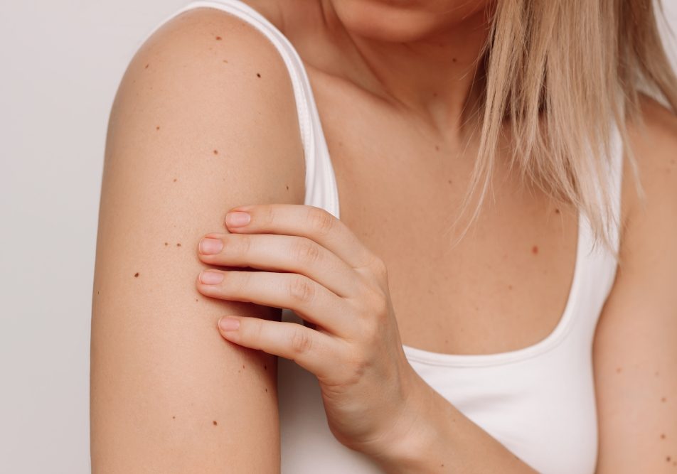 Donna si controlla la pelle per verificare eventuali cambiamenti e combattere il melanoma