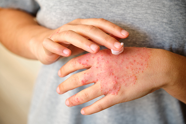Donna che cura la dermatite atopica applicando una crema idratante sul dorso delle mani