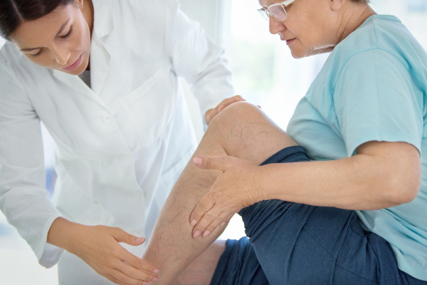 Donna con capillari rotti nelle gambe da dermatologo per capire se si tratta di flebite